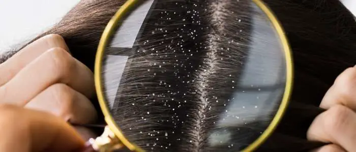 Dandruff caused for greasy hair